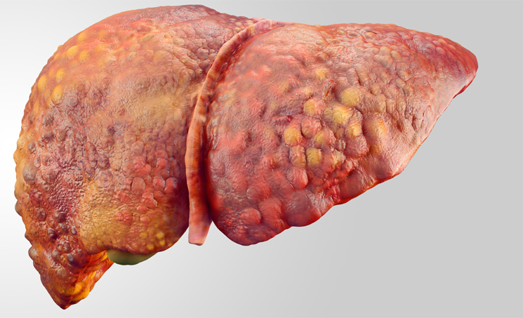 Niet-alcoholische leververvetting (NAFLD)