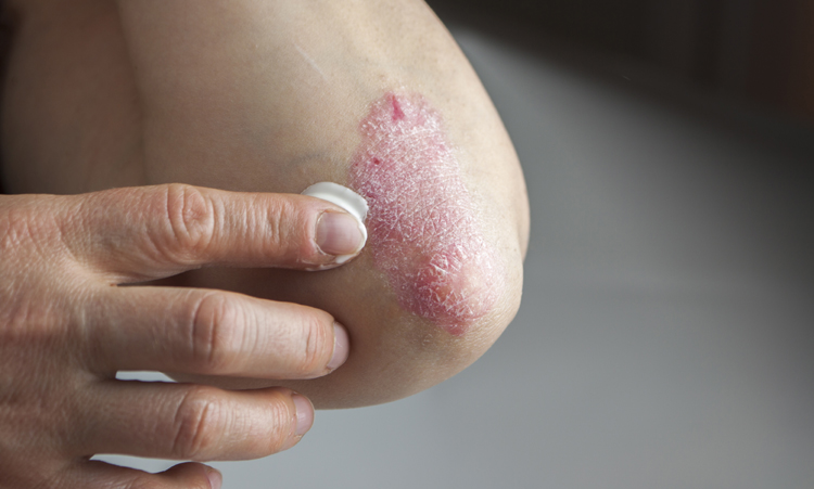 Psoriasis complementair behandeld