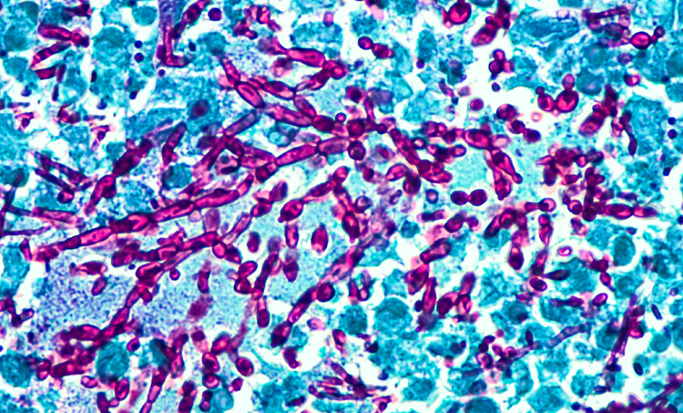 Relatie tussen schimmelinfecties en kanker